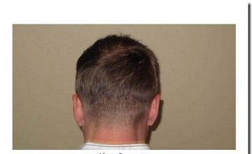 Hair restoration procedure results