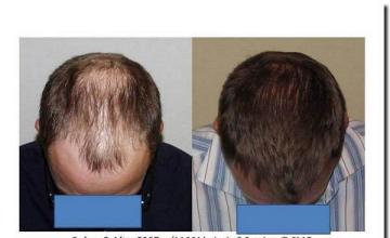 Hair restoration procedure results