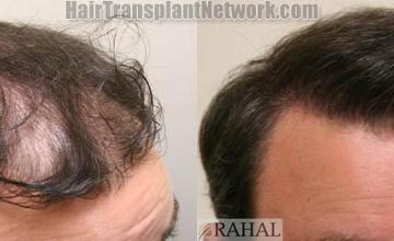 Hair transplantation surgery before and after photos