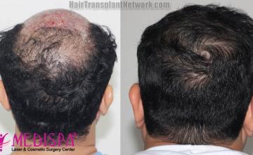 Surgical hair transplantation result photographs