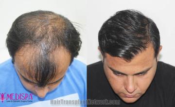 Hair transplantation surgery before and after images