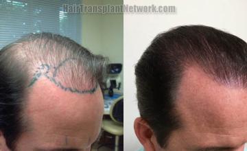 Hair transplantation procedure before and after results