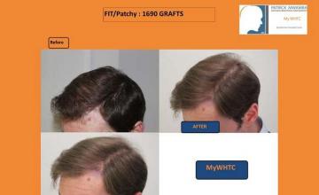 Hair restoration procedure before and after results