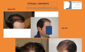 Hair transplantation surgery before and after images