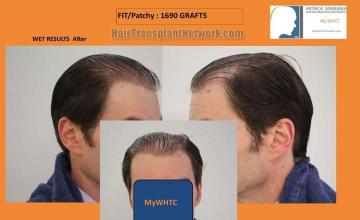 Hair transplantation surgery before and after pictures