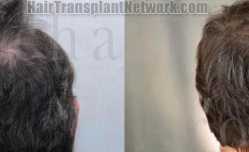 Hair replacement surgery before and after images