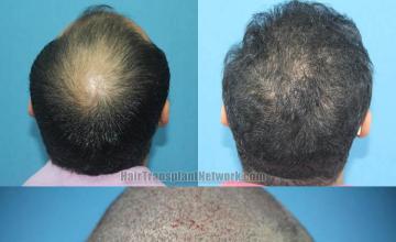 Surgical hair transplantation result photographs