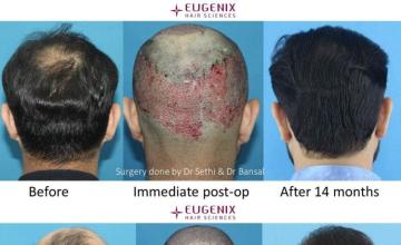 Surgical hair transplantation result photographs