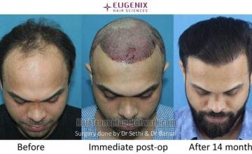 Before and after hair restoration procedure images