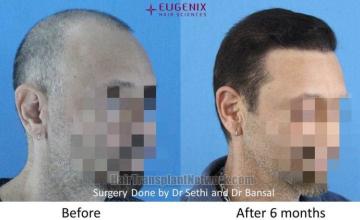 Hair transplantation procedure before and after results