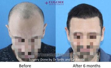 Before and after BHT FUE hair restoration procedure images