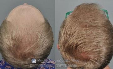 Surgical hair transplantation result photographs