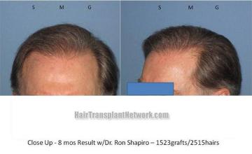 Closeup views of hairline after hair restoration