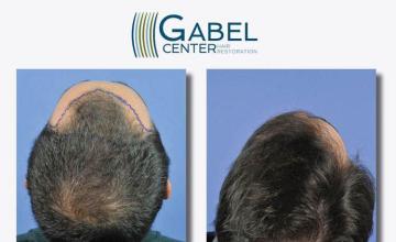 Hair restoration procedure before and after pictures