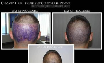 Hair transplantation procedure before and after photographs