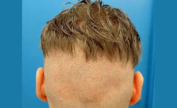 Surgical hair transplantation result photographs