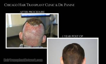 Surgical hair transplantation result photographs