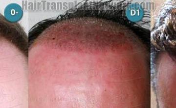 Hair transplantation surgery before and after pictures