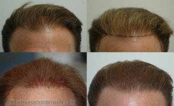 Hair transplantation surgery before and after photos