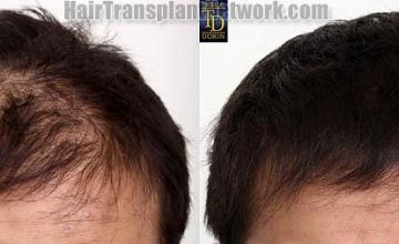 Hair restoration procedure before and after results