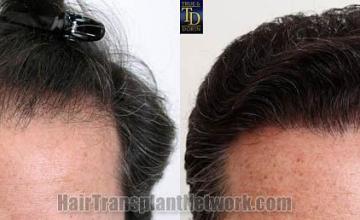 Hair restoration procedure before and after results,