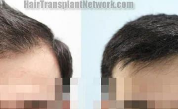 Hair restoration procedure before and after results