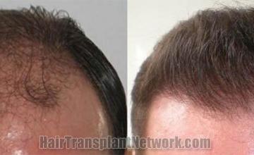 Hair restoration procedure before and after results