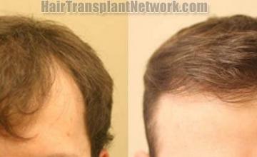 Hair restoration procedure before and after results