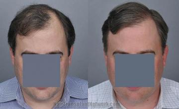 Hair restoration procedure before and after results