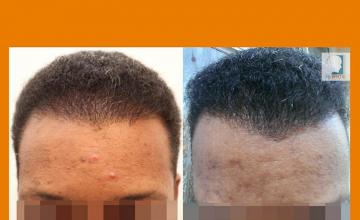 Before and after hair transplant procedure images