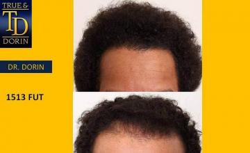 Hair transplantation surgery before and after images