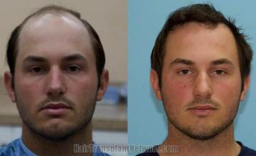 Before and after hair transplantation surgery