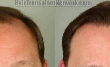 Front view - Before and after hair transplantation surgery