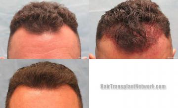 Before and after hair transplantation surgery