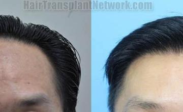 Front view - Before and after hair restoration procedure