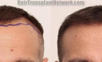 Front view - Before and after hair restoration procedure