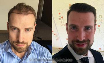 Front view - Before and after