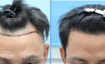 Front view - Before and after