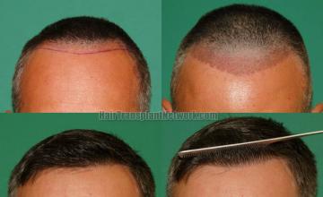 Before and after hair restoration procedure