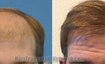 Front view - Before and after hair restoration procedure