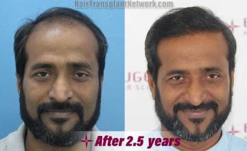 Front view - Before and after