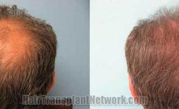 Back view before and after hair transplantation photos