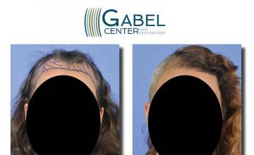 Hair transplantation surgery before and after images