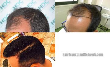 Hair transplantation surgery before and after pictures