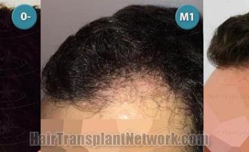 Hair transplantation surgery before and after photos