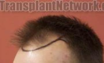 Hair transplantation surgery before and after images