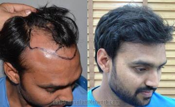 Hair transplantation surgery before and after photos