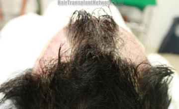 Hair transplant surgery before and after photos