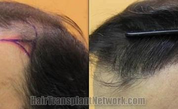 Hair transplantation surgery before and after images