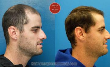 Hair restoration procedure before and after results